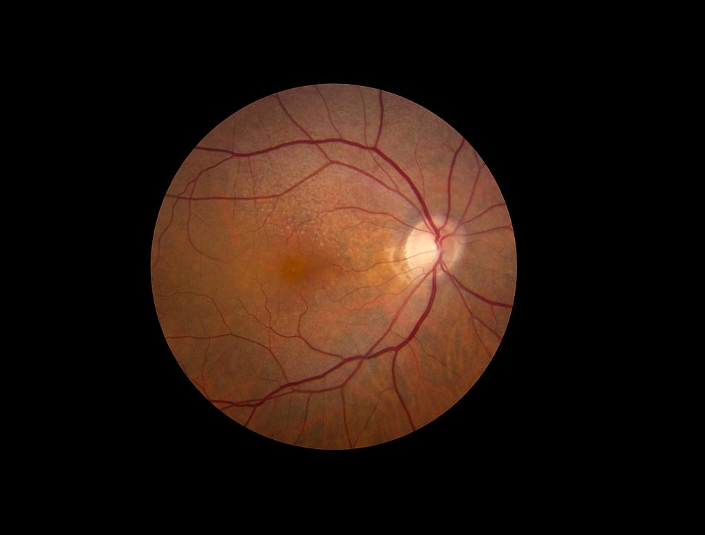 Vision, Diet, Cancer Breakthroughs